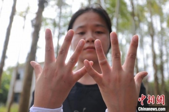 吳素英展示被蜜蜂蜇過的雙手。湯曉逵 攝