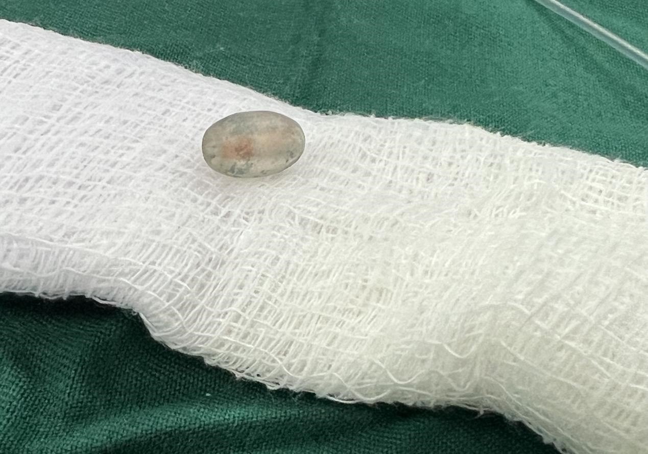 被取出的異物。中國援桑醫(yī)療隊供圖