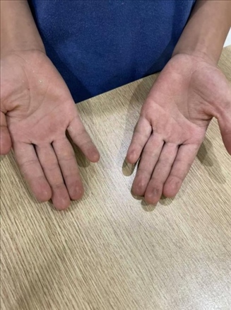 9歲小學(xué)生長(zhǎng)期拍煙卡，手部粗糙長(zhǎng)繭。受訪者供圖