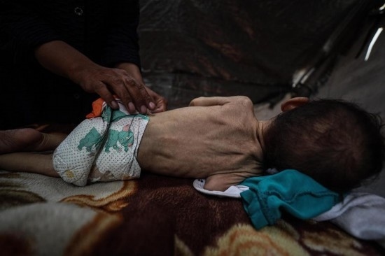這是5月28日在加沙城西部一處臨時安置點拍攝的一名營養(yǎng)不良的嬰兒。新華社發(fā)（馬哈茂德·扎基攝）
